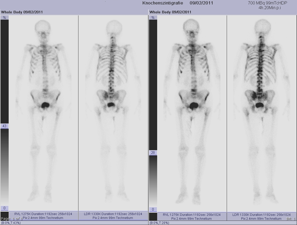 Whole-body bone scan reference image