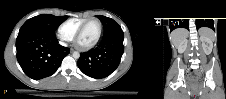 Axial and coronal CT scan of thorax and abdomen